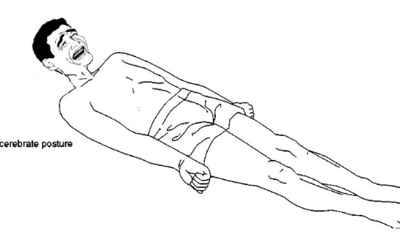 Decerebrer stivhed: hvad er dette, symptomer, diagnostik, behandling, forebyggelse