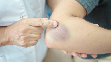 Jak se rychle zbavit modřiny doma, jak vyléčit hematom - Zranění