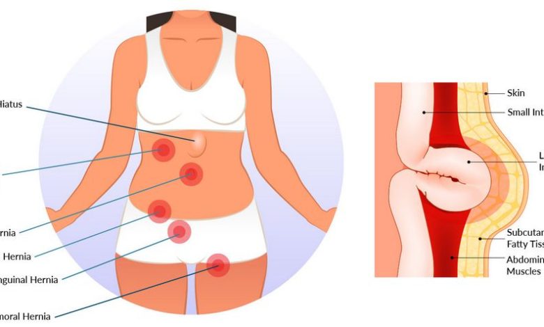 Boule sur le ventre, hernie abdominale: Qu'est-ce que c'est, symptômes, diagnostic, traitement, prévention