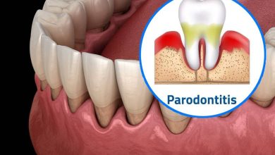 Parodontite: traitement des gencives à la maison remèdes populaires