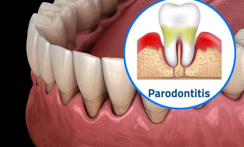 Parodontitis: Zahnfleischbehandlung zu Hause Volksheilmittel