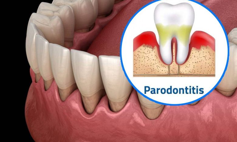 periodontitis: evde halk ilaçları ile sakız tedavisi