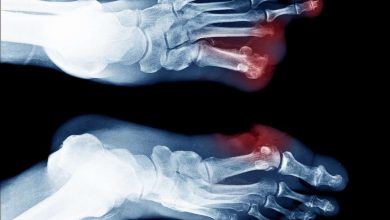 Ампутация ступни или пальца ноги: что это за операция, причины, противопоказания, как делают, что после - Рентген ноги - Нога, ступня, травма