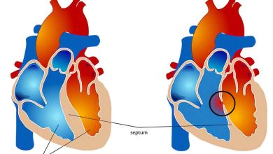 Canal atrio-ventriculaire: Qu'est-ce que c'est, symptômes, diagnostic traitement, prévention