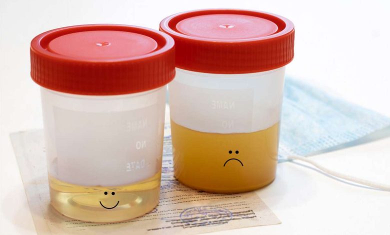 Welke ziekten troebele urine?: Wat is het, symptomen, diagnostiek, behandeling, het voorkomen