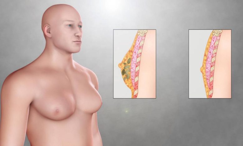 男性の女性化乳房: 原因, 症状, 診断法, タモキシフェン治療, クロミフェン