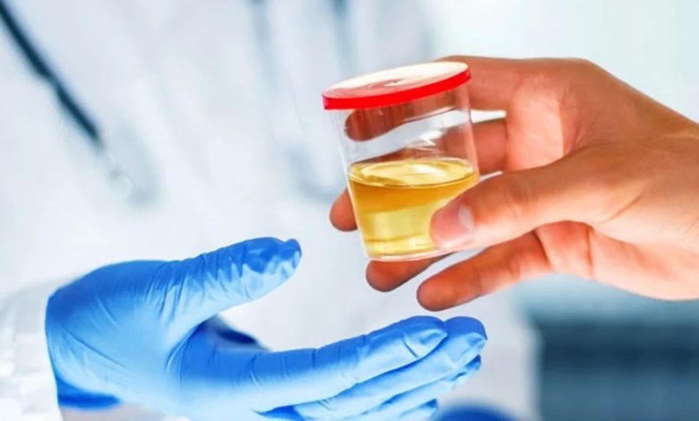 Bau urin yang tidak enak (urin bau): Apa itu, Gejala, diagnostik, pengobatan, pencegahan