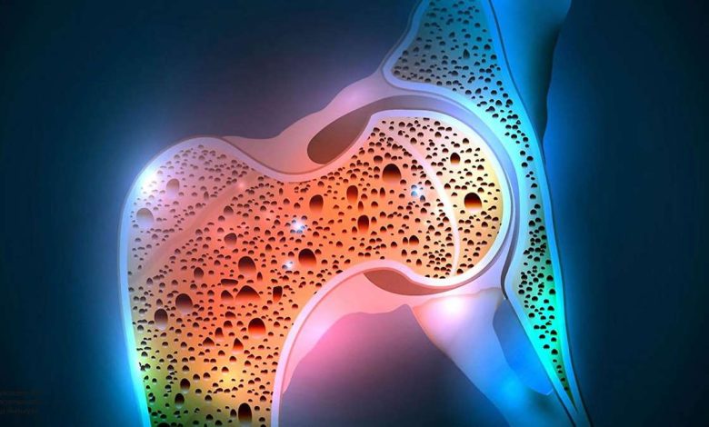 Osteoporoza, objawy i leczenie w domu metody ludowe. Osteoporoza to rak?