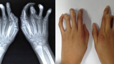 Arachnodactyly, "ämbliku sõrmed": mis see on, põhjused, sümptomid, diagnostika, ravi, luuvalu ennetamine