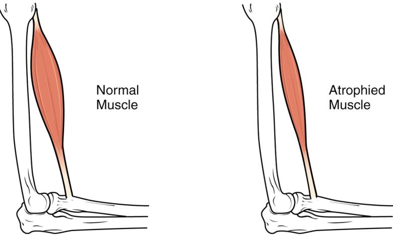 atrofia muscular: Que es esto, causas, síntomas, diagnóstico, tratamiento, prevención