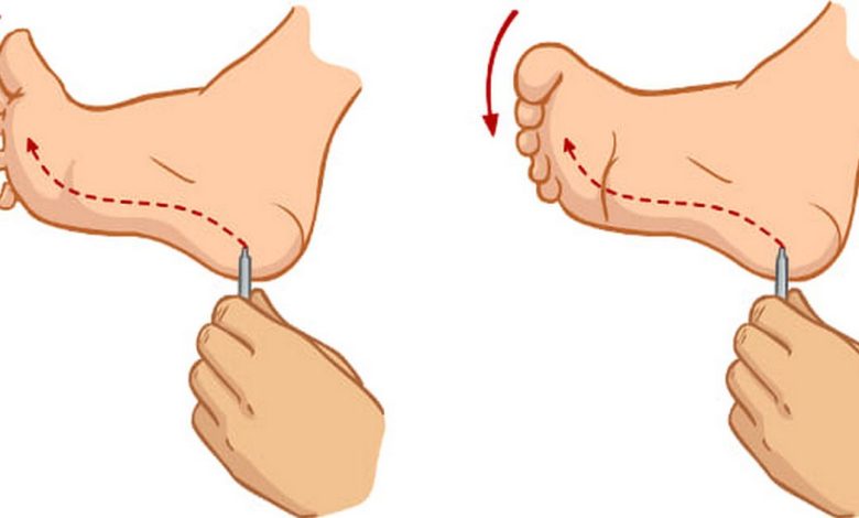 Babinski's reflex: what is this, causes, symptoms, diagnostics, treatment, prevention