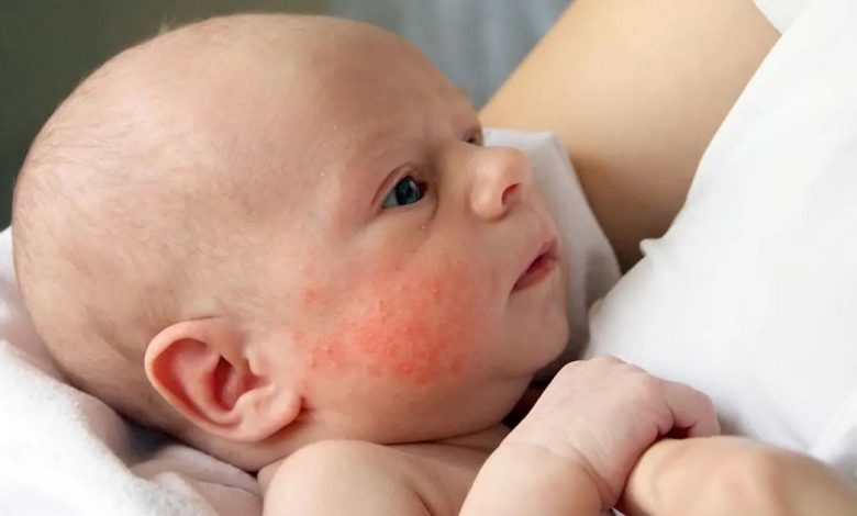 小時候寶寶出過皮疹 2 歲月: 這是什麼, 原因, 症狀, 診斷, 治療, 預防