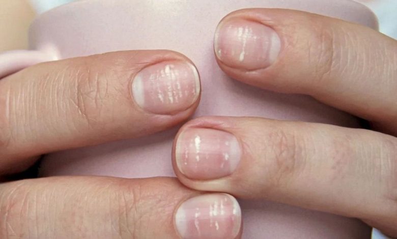 Аномалии ногтей, ломкие ногти: Apakah ini, sebab-sebab, gejala, diagnostik, rawatan, pencegahan
