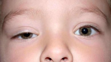 La omisión del siglo, ptosis en bebés y niños: Que es esto, causas, síntomas, diagnóstico, tratamiento, prevención - Ojos - Oftalmología