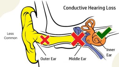 Điếc giác quan: Cái này là cái gì, nguyên nhân, triệu chứng, chẩn đoán, điều trị, phòng