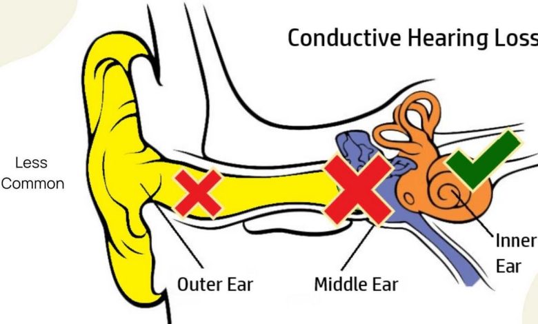 Sensorineuraalinen kuurous: mikä tämä on, syyt, oireet, diagnostiikka, hoito, ennaltaehkäisy