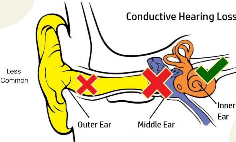 Điếc giác quan: Cái này là cái gì, nguyên nhân, triệu chứng, chẩn đoán, điều trị, phòng