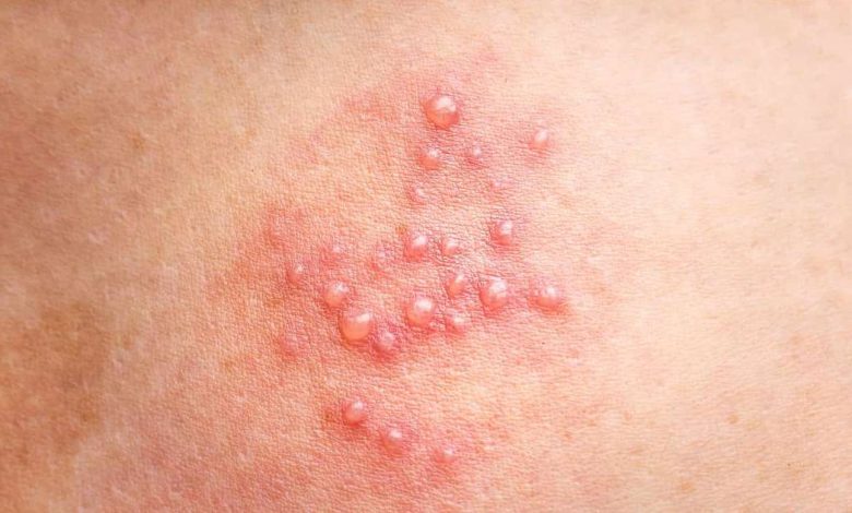 Cutaneous, Blisters, blisters on the skin: what is this, causes, symptoms, diagnostics, treatment, prevention