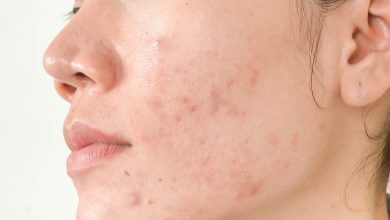 Comedons (акне, acne):què és això, causes, símptomes, diagnòstic, tractament, prevenció