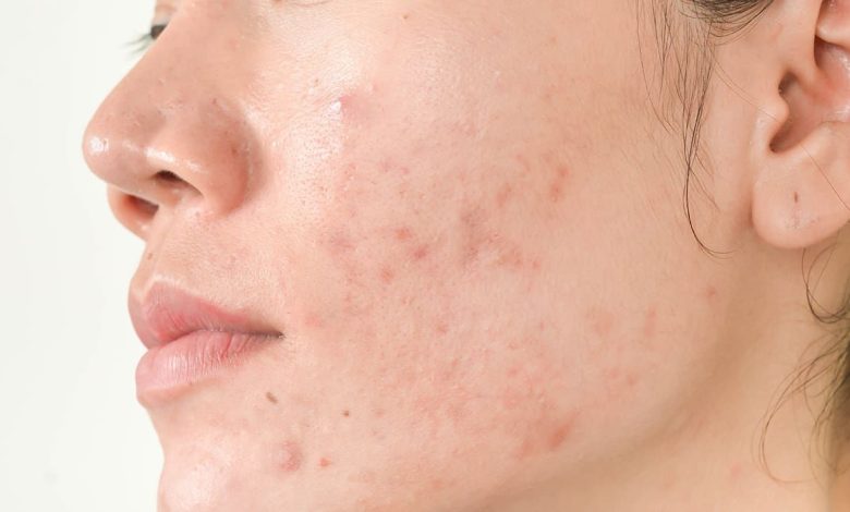 Comedonen (акне, acne):wat is dit, oorzaken, symptomen, diagnostiek, behandeling, het voorkomen