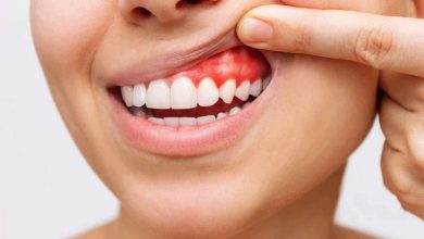 Blødende tannkjøtt: hva er dette, årsaker, symptomer, diagnostikk, behandling, forebygging - Tannbehandling - Tenner