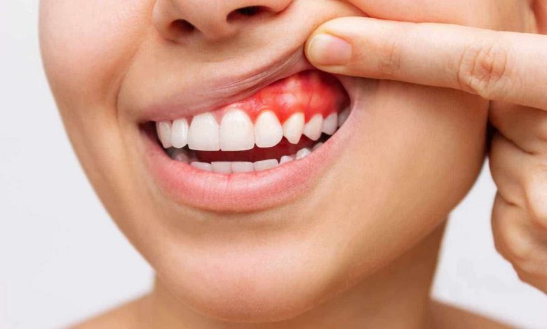 Bloedend tandvlees: wat is dit, oorzaken, symptomen, diagnostiek, behandeling, het voorkomen - Tandheelkunde - Tanden