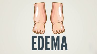 Zwelling van de voet, schenen en enkels, Eden: wat is dit, oorzaken, symptomen, diagnostiek, behandeling, het voorkomen