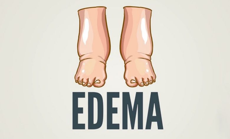 Gonflement des pieds, tibias et chevilles, Eden: qu'est-ce que c'est, les causes, symptômes, diagnostic, traitement, prévention