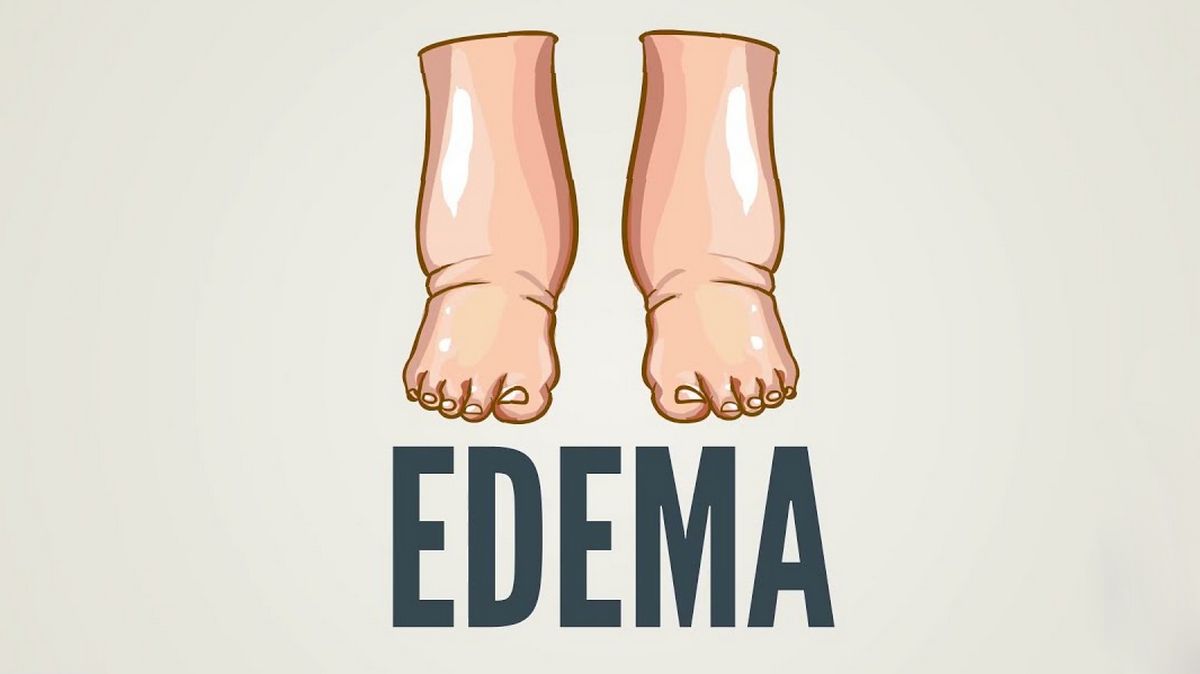 Edema Foot Swelling Shins And Ankles What Is This Causes Symptoms Diagnostics Treatment 1067
