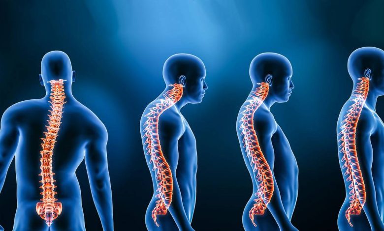 Lordosis, hunched back: what is this, causes, symptoms, diagnostics, treatment, prevention
