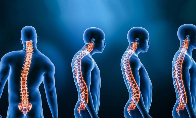 Lordosis, görnyedt hátra: mi ez, okai, tünetek, diagnosztika, kezelés, megelőzés