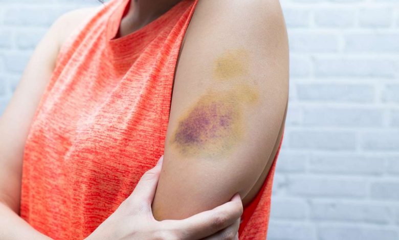 Hemorrhage into the skin, purpura: what is this, causes, symptoms, diagnostics, treatment, prevention - Bruise - Injury