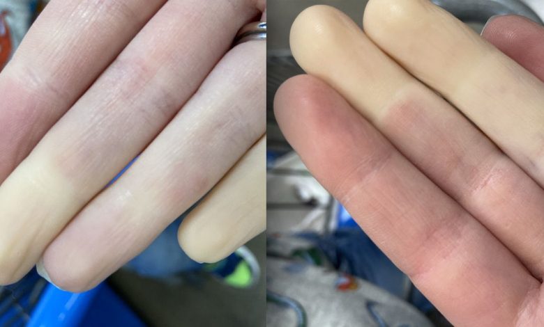 Изменение цвета пальцев рук и ног: что это, причины, симптомы, диагностика, лечение, профилактика