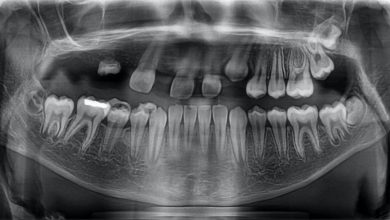 牙齒形成延遲或沒有: 這是什麼, 原因, 症狀, 診斷, 治療, 預防
