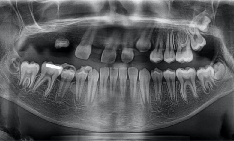 Dente retardado ou sem formação: O que é isto, causas, sintomas, diagnóstico, tratamento, prevenção