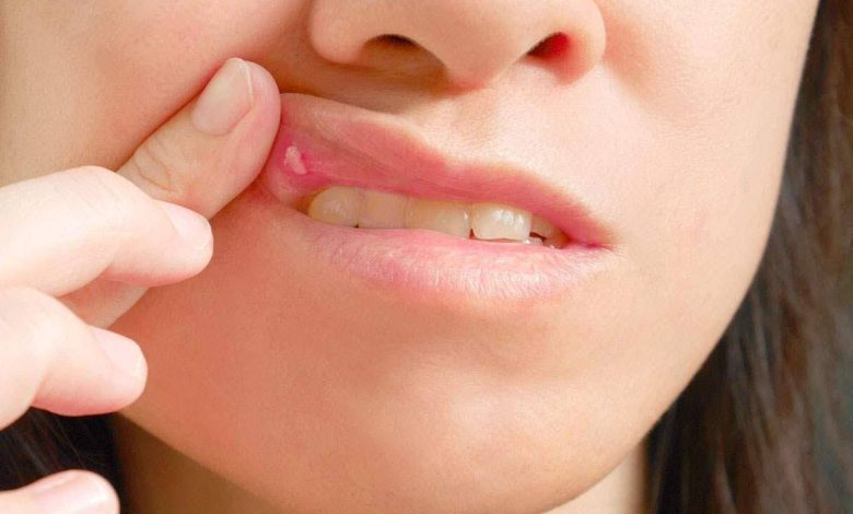Suuhaavandeid, haavandid suus: mis see on, põhjused, sümptomid, diagnostika, ravi, ennetamine