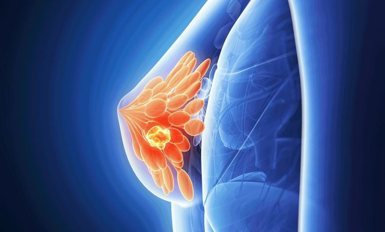 Guzki piersi u kobiet, guz w klatce piersiowej: co to jest, Przyczyny, Objawy, diagnostyka, leczenie, zapobieganie - Rak piersi, Pierś
