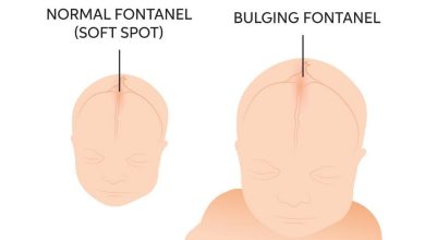 penonjolan (letupan) fontanel bayi: Apakah ini, sebab-sebab, gejala, diagnostik, rawatan, pencegahan