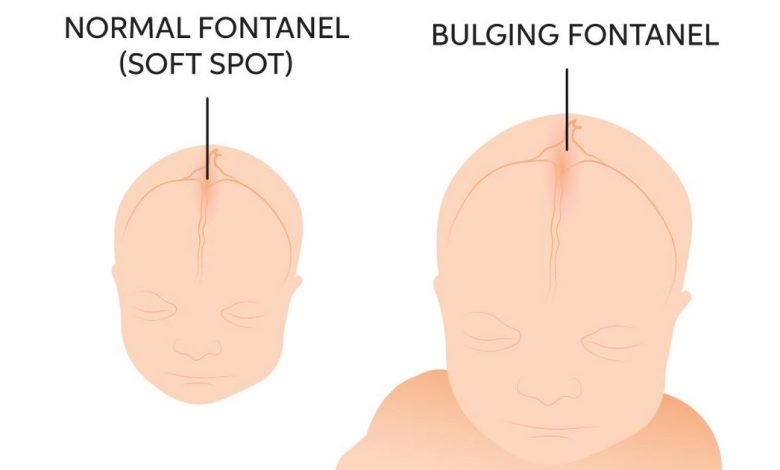 uitsteeksel (explosie) fontanel van de baby: wat is dit, oorzaken, symptomen, diagnostiek, behandeling, het voorkomen