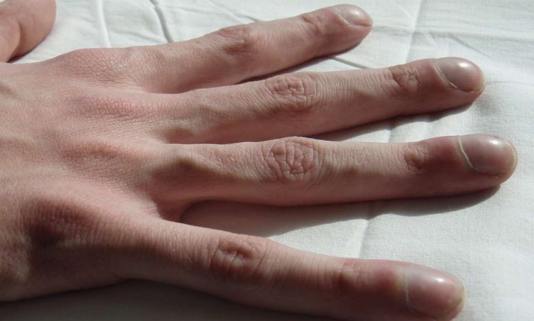סימפטום של מקלות תופים, אצבעות תוף: מה זה, סיבות, סימפטומים, אבחון, טיפול, מניעה - עיבוי של אצבעות ואצבעות