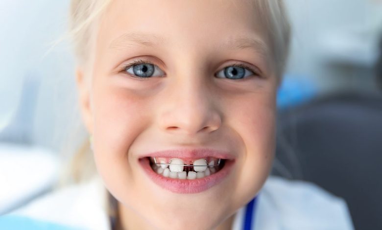 Espaços entre os dentes, diastema: O que é isto, causas, sintomas, diagnóstico, tratamento, prevenção - Odontologia