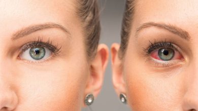 Czerwone oczy: co to jest, Przyczyny, Objawy, diagnostyka, leczenie, zapobieganie - Okulistyka