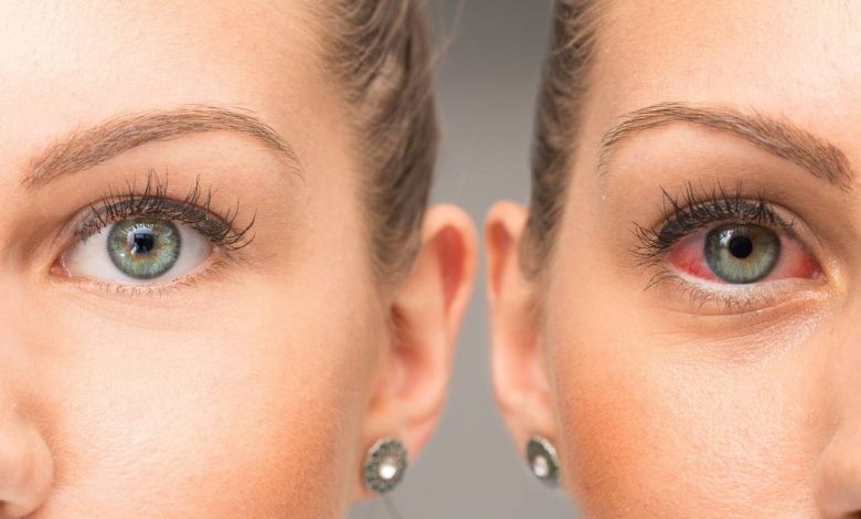 Kırmızı göz: bu nedir, nedenleri, Semptomlar, tanılama, tedavi, önleme - oftalmoloji