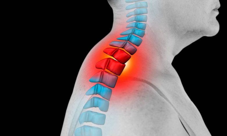 Buffalo hump, widow's hump, dorsocervical fat layer: what is this, causes, symptoms, diagnostics, treatment, prevention - Spine - Back