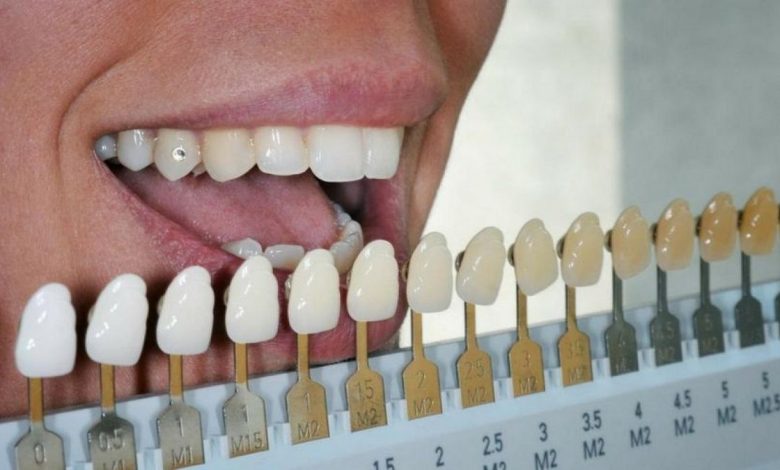 צבע שיניים לא נורמלי (מחשיכה, הַלבָּנָה): מה זה, סיבות, סימפטומים, אבחון, טיפול, מניעה - רפואת שיניים