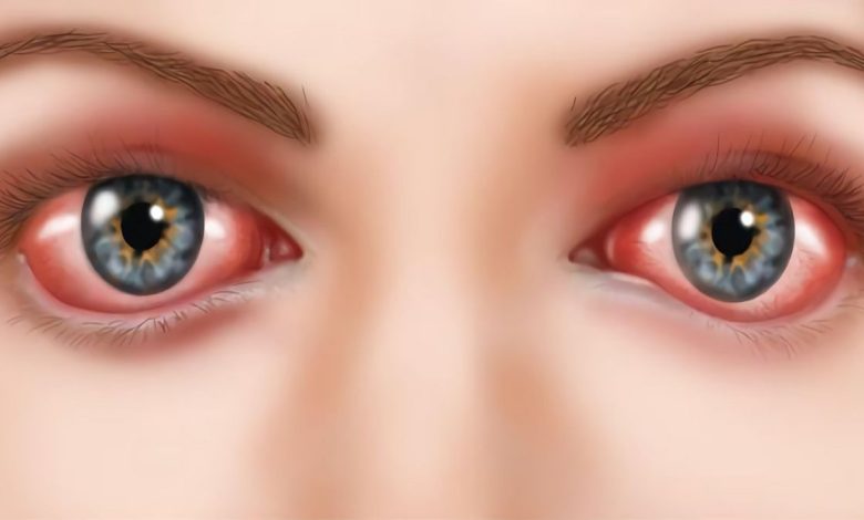 Kemoz, konjonktivanın şişmesi: bu nedir, nedenleri, Semptomlar, tanılama, tedavi, önleme - Göz - oftalmoloji