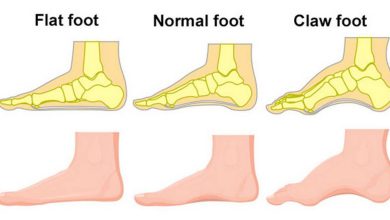 ความผิดปกติของนิ้วเท้าเล็บ: นี่คืออะไร, สาเหตุ, อาการ, การวินิจฉัย, การรักษา, การป้องกัน - เท้าแบน