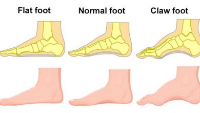 Deformitat del dit de l'arpa: què és això, causes, símptomes, diagnòstic, tractament, prevenció - Peu pla