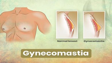 La ginecomàstia, augment de pit masculí: què és això, causes, símptomes, diagnòstic, tractament, prevenció