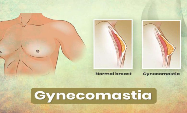Gynaecomastie, mannelijke borstvergroting: wat is dit, oorzaken, symptomen, diagnostiek, behandeling, het voorkomen